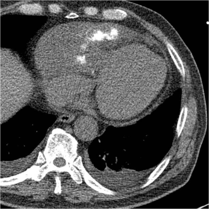 - Woo-Jung Chun, et al. A case of malignant pericardial mesothelioma with atypical CT and MR imaging pattern - A B Figure 3.