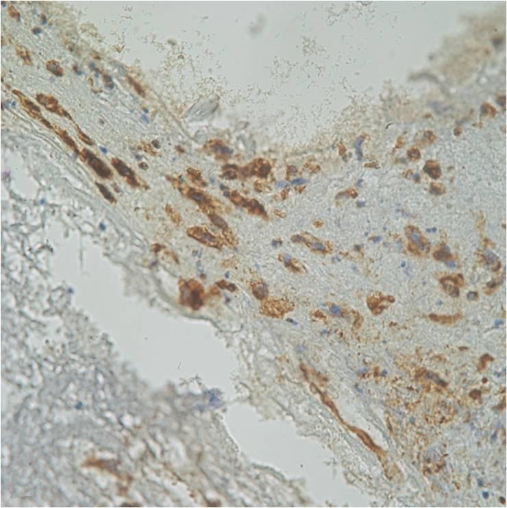 (B) Immunohistochemical staining with vimentin was positive ( 400).