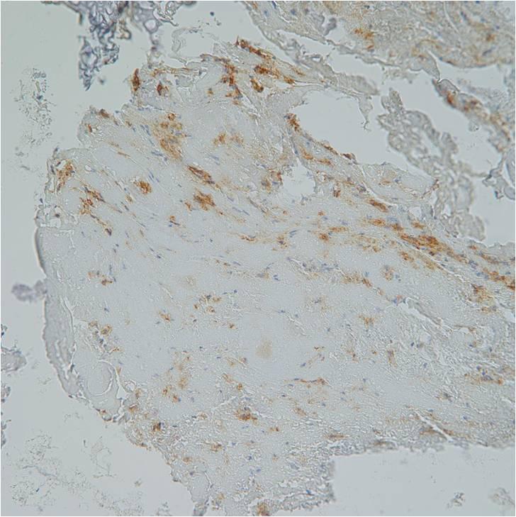 (D) Immunohistochemical staining with cytokeratin AE1/3 was focal positive ( 400).