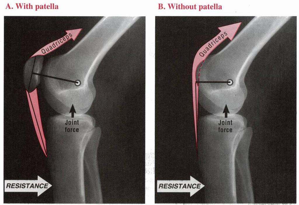 Without patella 20% loss of internal moment arm needs