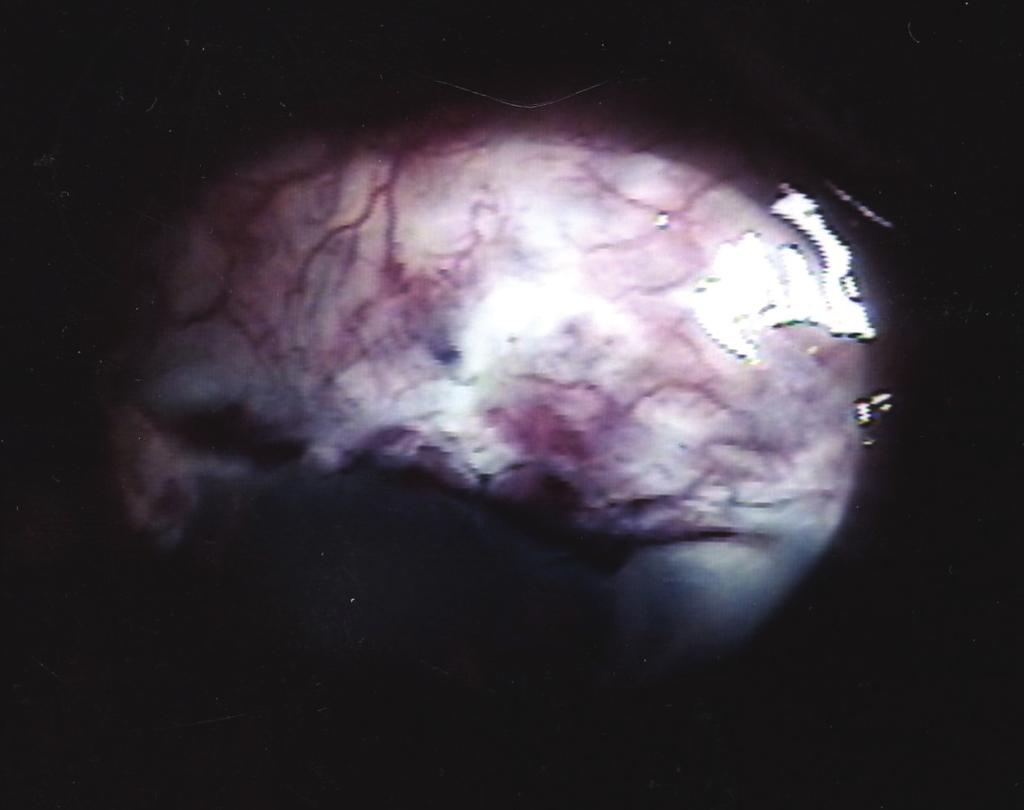 배지현외 : 자가테논낭이식 A B Figure 3. (A) Three weeks postoperative picture. It showed ingrowth of fibrovascular patch over the Tenon s capsule graft.