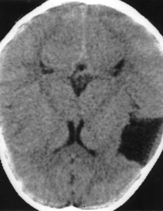 1. The arachnoid cyst shows various mass effects.