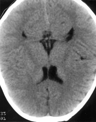 B Computed tomography shows an arachnoid cyst in the left middle cranial fossa