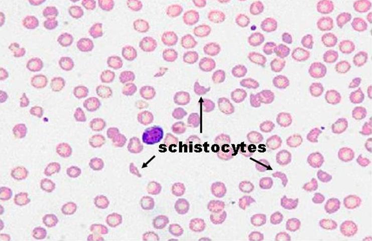 대한산부회지제 53 권제 5 호, 2010 Fig. 1. Schistocytes are scattered in peripheral blood smear. 내원익일분만직후시행한복부초음파상간비장비대, 경증의우측수신증및흉막삼출액이관찰되었다.