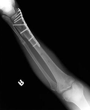88 Vol. 19 No. 3, September 2015 Figure 3. () This photograph demonstrate locking compression plate distal medial tibia (LP-DMT; Synthes, Solothurn, Switzerland).