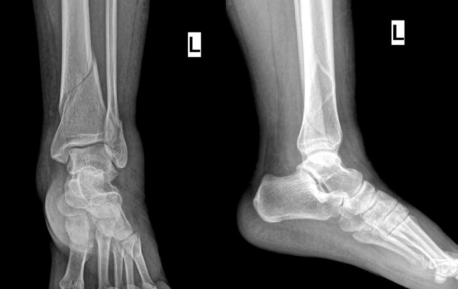 (A) Initial ankle anteroposteroior and lateral radiographs show distal tibio-fibular shaft comminuted fracture.