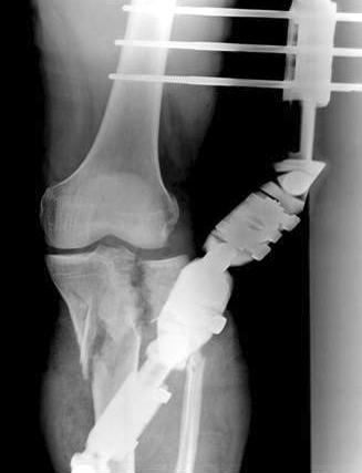 (G, H) The radiographs shows fixation with lateral periarticular plate medial