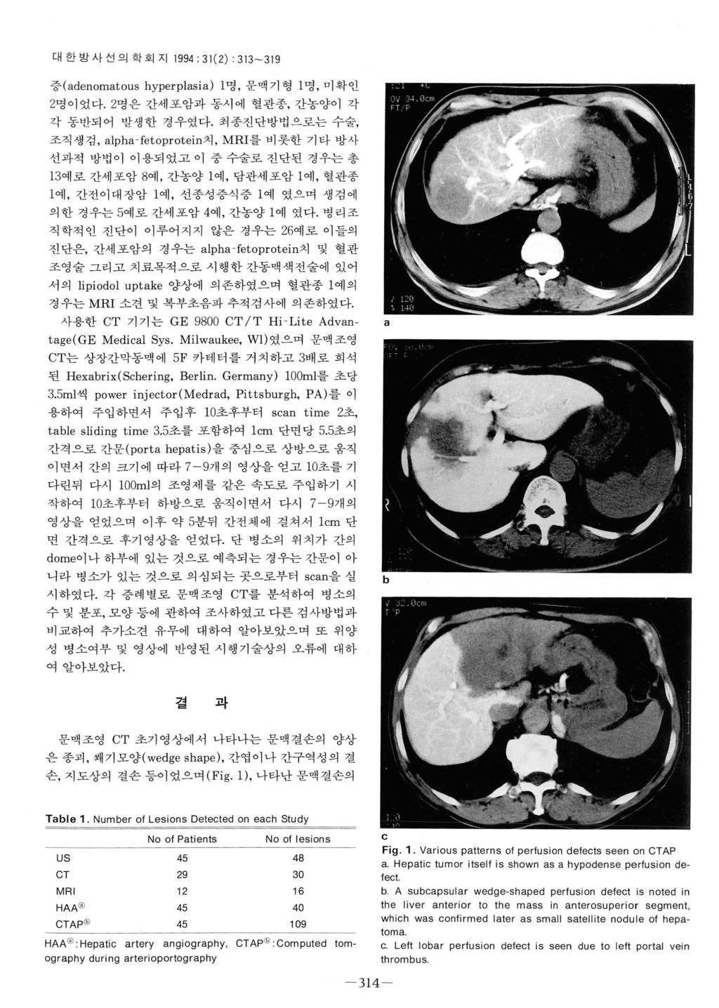 대한방사선의학회지 1994 : 31(2) : 313-319 증 (denomtou s hyperplsi) 1 명, 문맥기형 1 명, 미확인 2명이었다. 2명은칸세포암과동시에혈관종, 간농양이각각동반되어발생한경우였다.