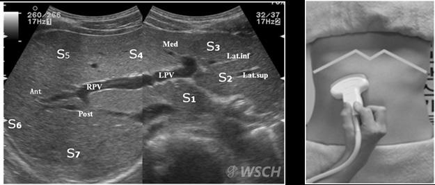 The Liver Week 2018 3) 늑골궁하주사 (Right subcostal scan) 탐촉자가늑골궁하 (subcostal margin) 에위치하는검사법으로, 간우엽을묘사하는방법이다. 탐촉자의각도를머리쪽 (cephalad) 으로주면간정맥이보이고, 각도를다리쪽 (caudal) 으로주면간의하방향이보인다.