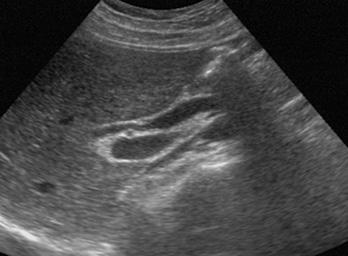 2) 우늑골궁하스캔 (Right subcostal scan) 문맥의수평부를관찰하여, 좌측간내담관을관찰할수있다.