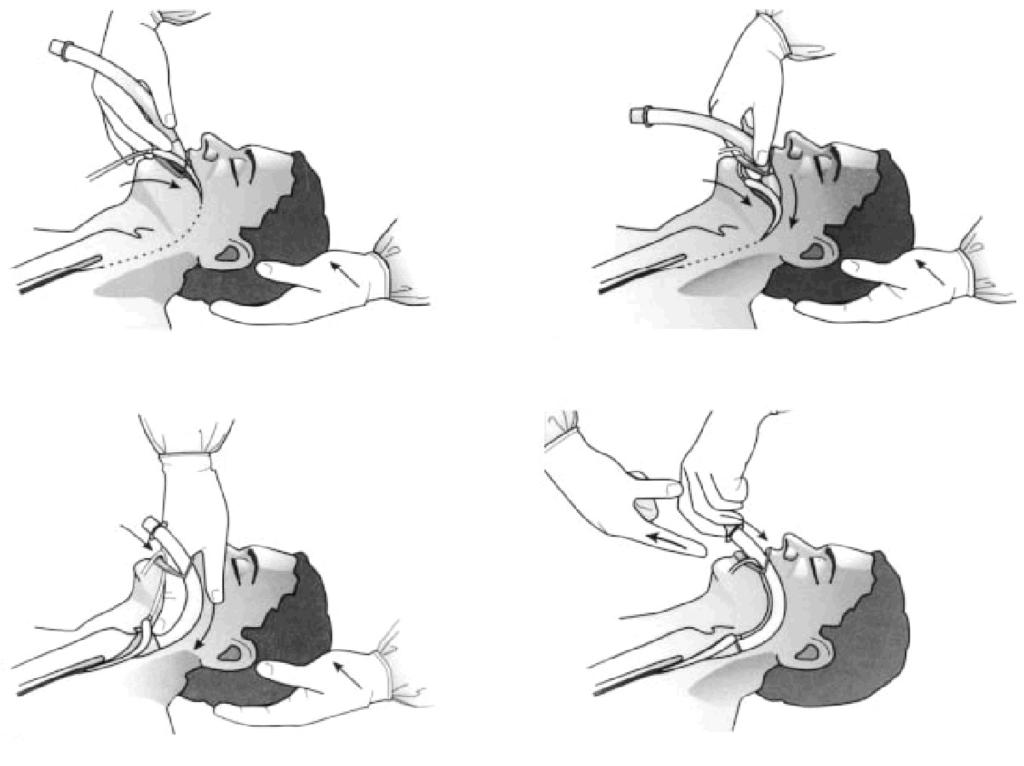 Kim SO A C Figure 3. Insertion of the laryngeal mask airway (LMA). A) The tip of the cuff is pressed upward against the hard palate by the index finger while the middle finger opens the mouth.