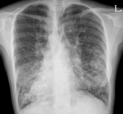 - 백경현외 6 인 : Kartagener 증후군환자에서시행한비침습적환기치료 - Figure 1. Chest radiography showing dextrocardia and scattered reticulonodular opacity on both lower lung fields. 이후이탈에많이사용되고있다 2, 3).