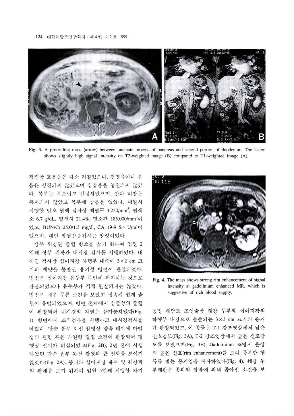124 대한체당도연구회지제 4 권제 2 호 1999 Fig. 3. A protmding mass (aπow) between uncinate process of pancreas and second portion of duodenum.