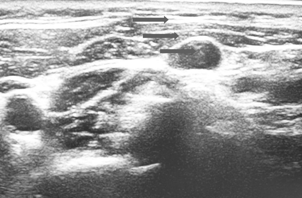 REFERENCES Fig. 4. Operation field after intraoperative ultrasound-guided vital dye injection in patient with recurrent papillary thyroid carcinoma in right level II lymph node.