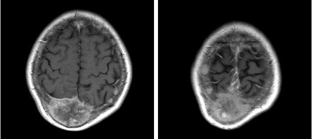 - Sang Ock Kim, et al. Brain metastasis form scirrous type hepatocellular carcinoma - A B Figure 1.