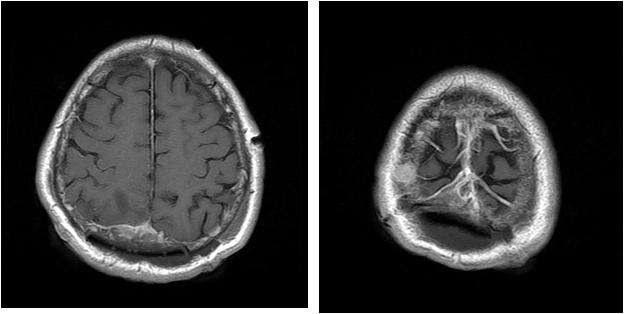 - 김상옥외 6 인. 뇌종양으로부터진단된경화형간세포암 - A B Figure 5. Brain MRI images after removing the brain mass from the vertex area (A), although the small lesions in the parietal area remain in the enhanced scan (B).