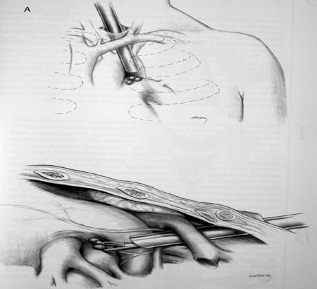 innominate artery Presence of tracheostomy 혹자는 standard cervical mediastinoscopy 외에추가로동측의 scalene lymph node를박리하는것을권하고있다.