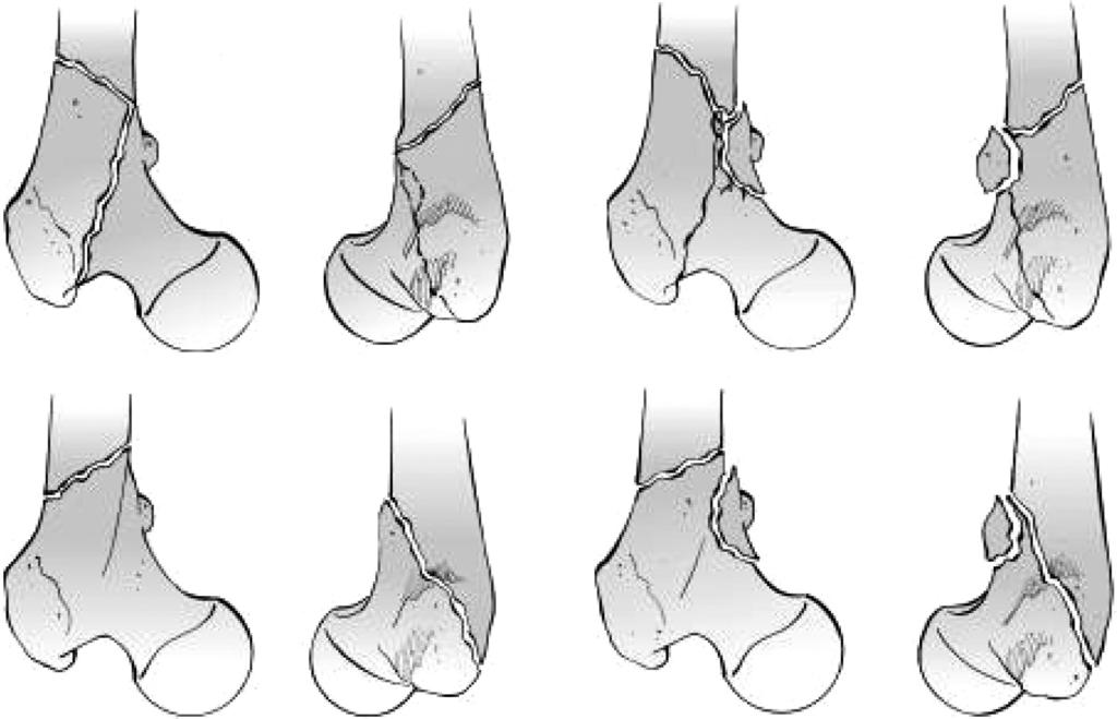 특징적으로근위골편은소전자에부착하는장요근건 (iliopsoas tendon) 의견인에의해굴곡 (flexion), 고관절의외회전근 (short external rotators) 에의해외회전 (external rotation) 그리고중 둔근 (gluteus medius) 에외전 (abduction)