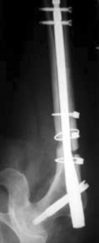 () Postoperative X-ray after open