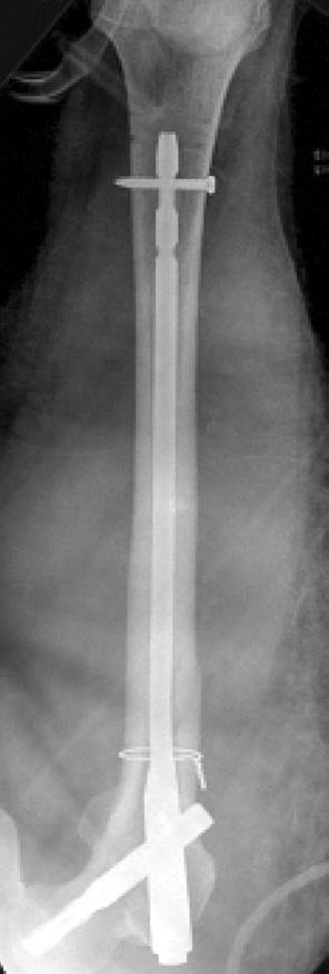 (C, D) X-ray taken 3 months after