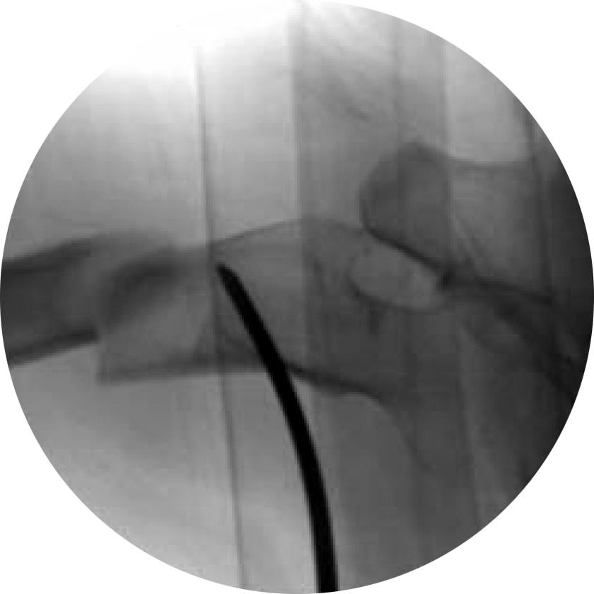 lateral images of an insufficiency fracture.