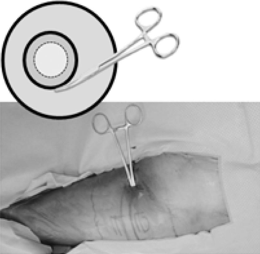 () Intraoperative compression view by forcep at