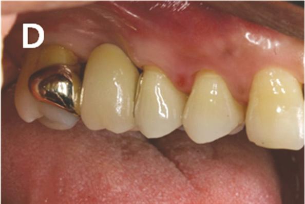 Occlusal and buccal view after