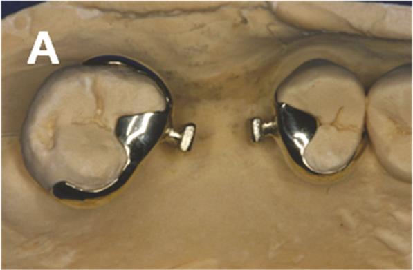 Occlusal and palatal view of