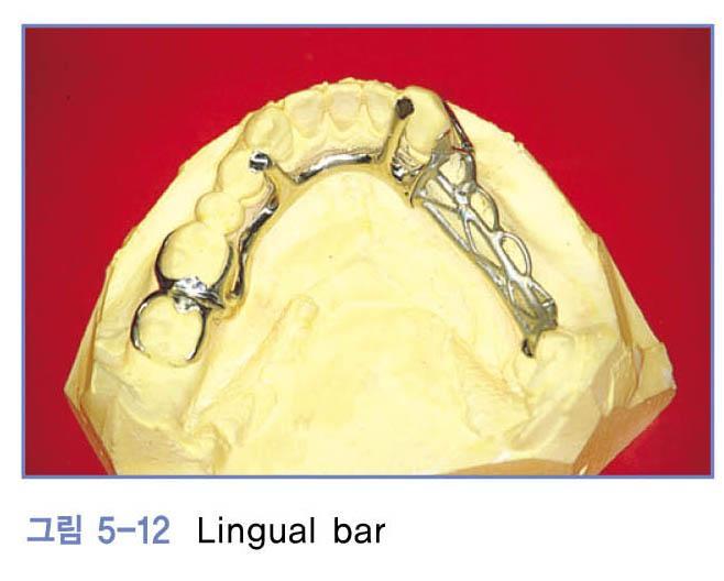 Lingual bar - 하악주연결장치로가장흔히사용 1) 특징 a. half pear form b. 넓이 : 4-5mm, 두께 : 2-3mm c.
