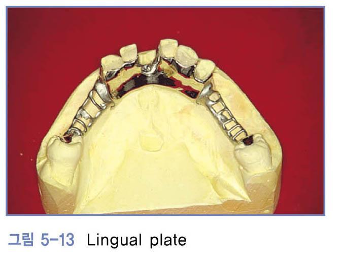 Linguoplate - lingual bar 의상부에서치아의설면까지얇은금속으로연장된연결장치 1) 장점 a.