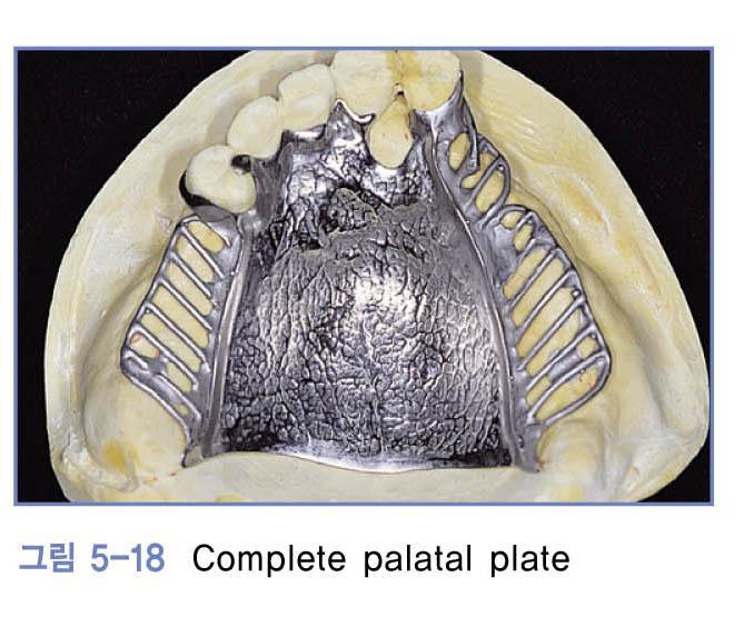Complete(Full) palatal plate - 구개의대부분을덮은 major connector 1) 적응증 a.