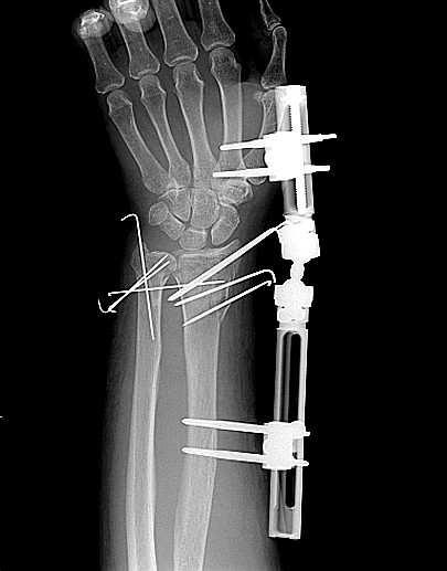 and lateral wrist X-ray of 62 years old female patient