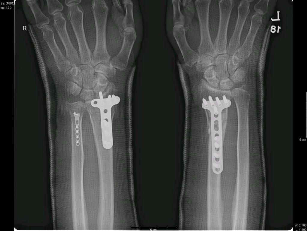 wrist X-ray of 59 years old