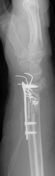 lateral wrist X-ray