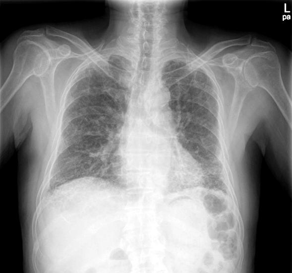Ewha Med J Vol. 36, No. 1, 2013 Fig. 3. (A) Initial chest x-ray shows reticular opacity in both lower lobes.