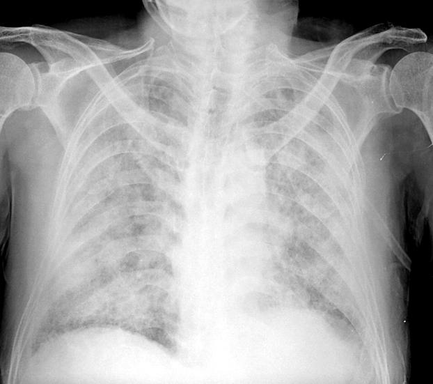그러나이후 3일뒤환자는다시호흡곤란을호소하였으며흉부 X-선촬영에서악화소견을보여기계호흡을적용하고중환자실치료를시행하였다. 그후약 4주