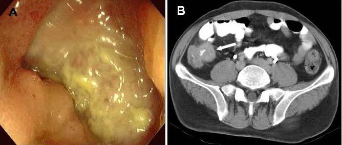 (A) Colonoscopy shows a large, deep ulcer in the terminal ileum. (B) Abdominal computed tomography (CT) shows bowel wall thickening of the terminal ileum (arrow). Figure 3.