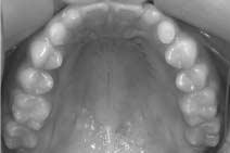 영구견치의위치를확인하기위해일반방사선사진및 3 Dimensional Dental-Computerized Tomography를촬영하였다.