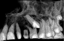 이식치아의치근막손상을줄이기위해과도한 hand instrument 조작보다는인접골을삭제하여매복견치에접근하였다 (Fig. 1-5, 6). #13, 23 치아를각각수용부에시적한후대합치와교합을확인하였다.