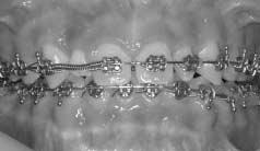 영구견치의위치를확인하기위해일반방사선사진및 3D Dental-CT를촬영하였다.