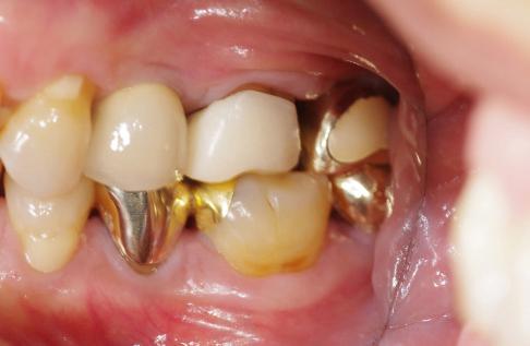 Study model 1 month after removal of upper left