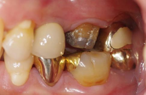 Planning for preparation of mesial side