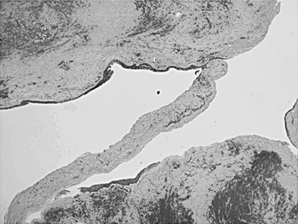 - 대한안과학회지 2010년 제 51 권 제 7 호 - C D Figure 3. Histopathology of the cyst. () Low magnification view shows an unilocular cyst which had even wall thickness of 1 mm.