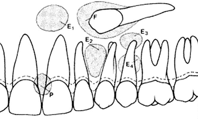 J Korean Acad Pediatr Dent 38(4) 2011 Ⅱ. 증례보고 10세의여아가하악우측측절치가나지않는다는것을주소로내원하였다. 특별한의학적병력및치과적병력은없었다. 임상검사에서하악좌측측절치는맹출하였으나하악우측측절치는관찰되지않았다 (Fig. 2).