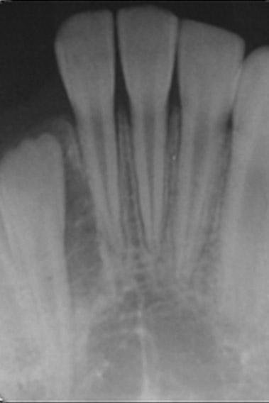 Extrafollicular type has no relation with an impacted tooth, may be confused residual, radicular or lateral periodontal cyst.