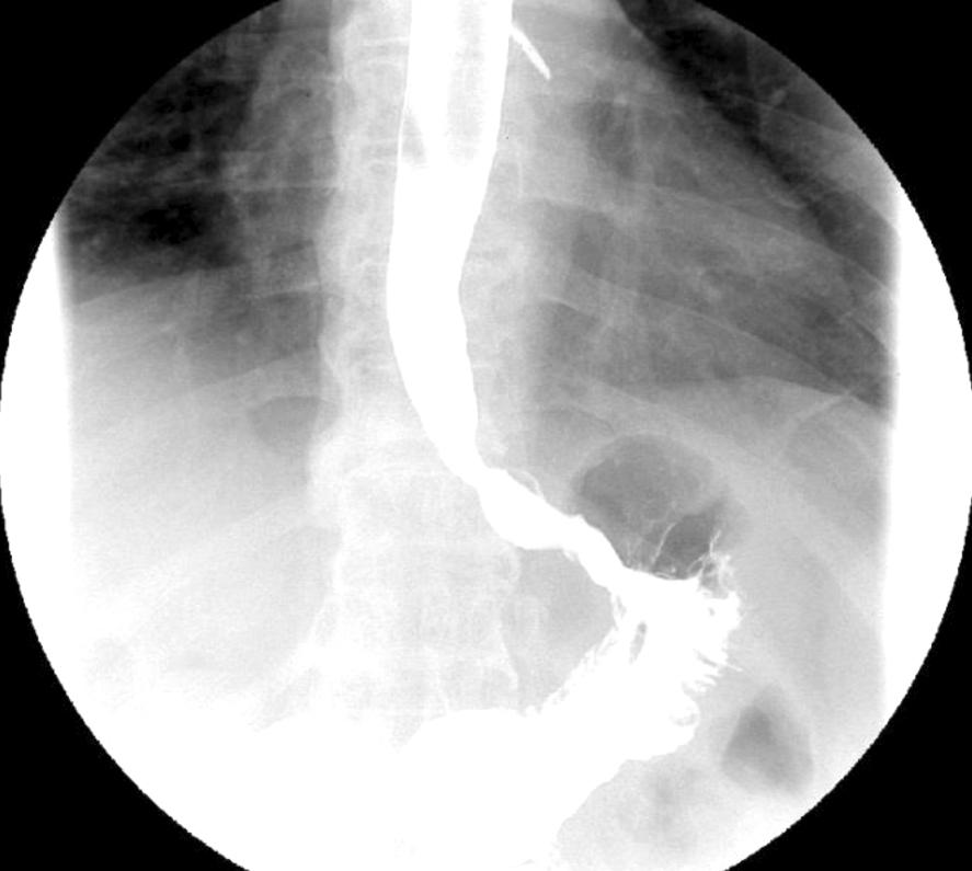 Min Su Chu, et al: Early Detection of Anterior Cervical Osteophytes Causing Dysphagia by EGD 생한 외부 압박으로 관찰되었으며, 관내강이 매우 협소하여 이 상동으로 진입시 심한