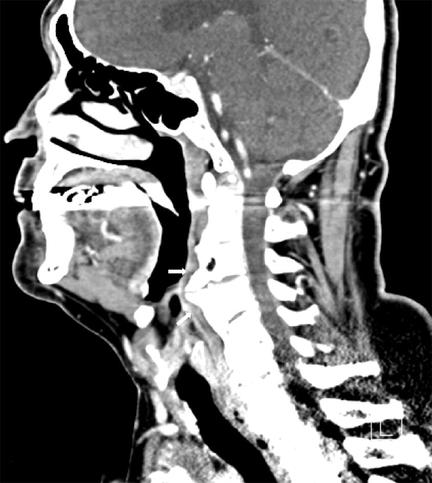 란의 관련성이 낮은 것으로 판단하여 제외하였다. 수술 후 촬영 한 경부 단순 방사선 사진에서 골극이 제거된 소견을 볼 수 있 다(Fig. 1B).