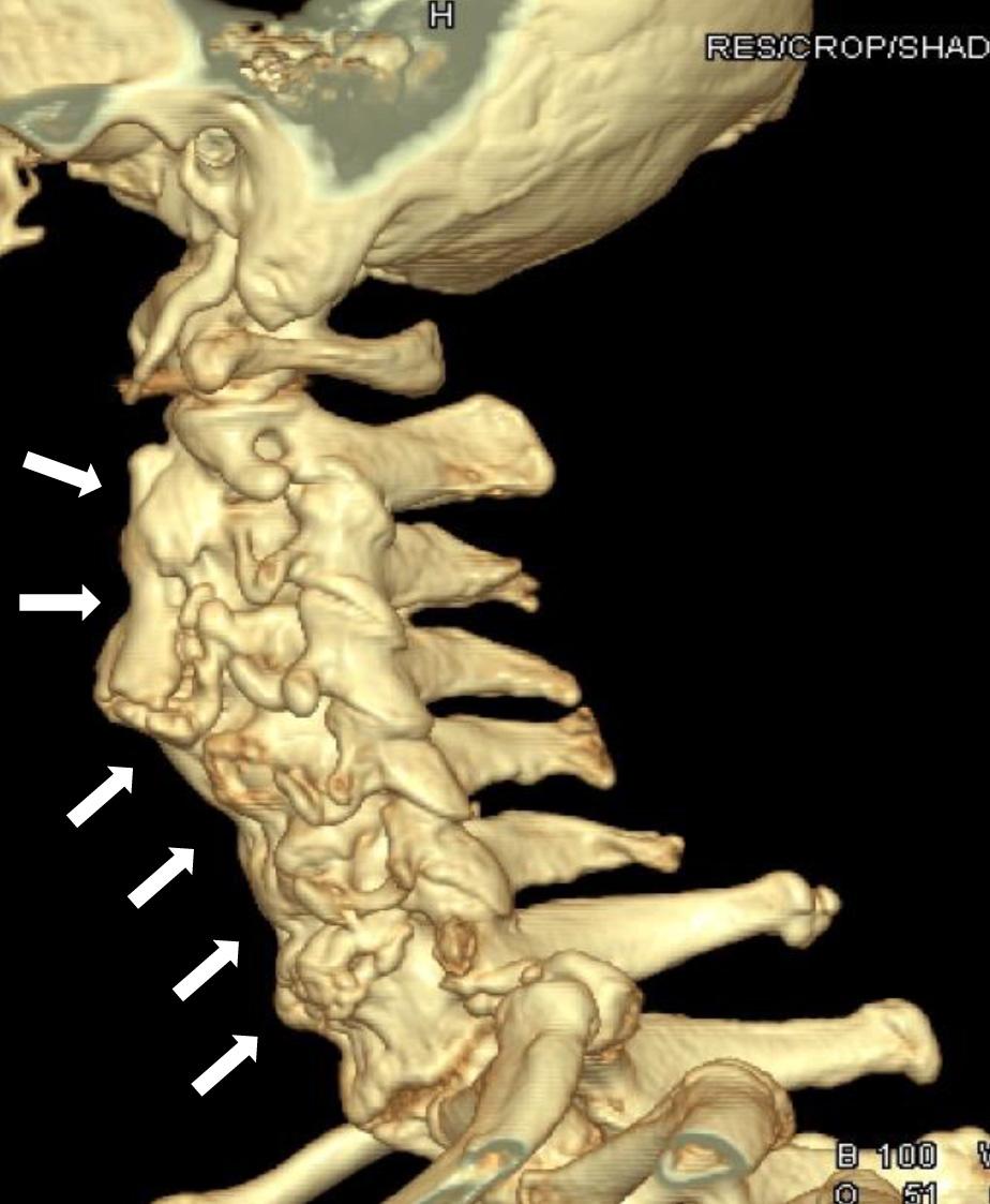 (A) The prominent osteophytes, especially C-spine 3, 4 level (arrows), are shown on the CT with pharyngeal wall deformity.