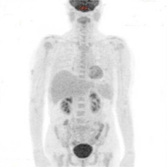 (D) Factor VIII stain indicating the intravascular location