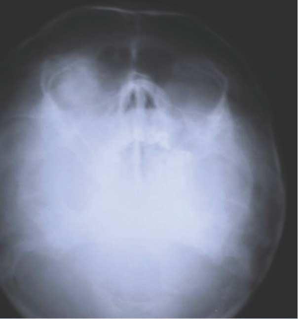 Chest PA radiograph